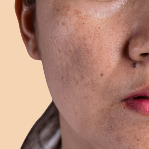 day night cream for pigmentation